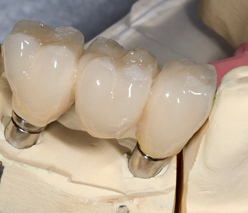Conventional, conservative dental crown procedure suits patients’ unique needs in Rochester Hills
