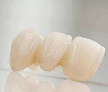 Close teeth gap with permanent dental bridges from dentist in MI