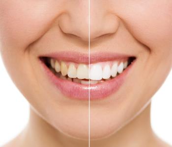 Rejuvenate your smile with Zoom teeth whitening from dentist in Rochester Hills, MI