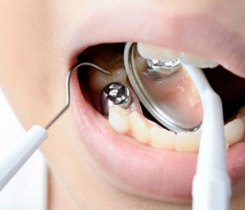 Dental Tooth Filling Rochester Hills MI