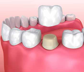 Dr. John Aurelia provides advanced and effective dental crowns & bridges service in Rochester MI.