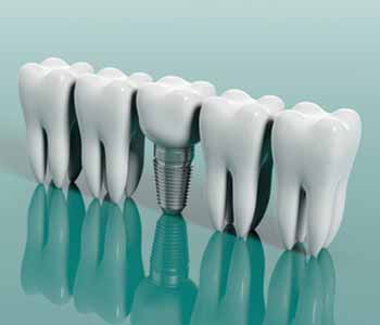 Drs. John Aurelia and Dina Khoury of Rochester, MI assist patients with dental implants, along with other dental restoration options for one or more missing teeth.