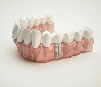 Types of Dental Implants and Techniques in Rochester area