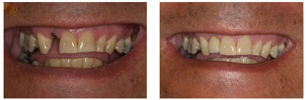 Dental Implants Before and After Results in Rochester Hills