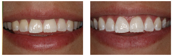 ZOOM Whitening Procedure before and after rochester hills
