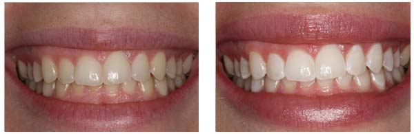ZOOM Whitening Procedure before and after results rochester hills