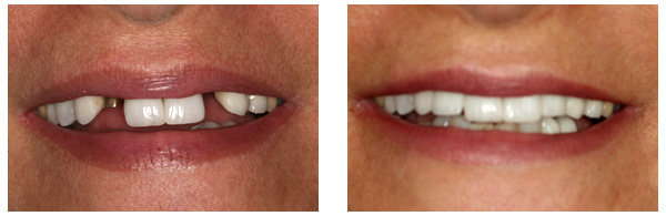 Dental Implants before and after results of a patient in Rochester Hills