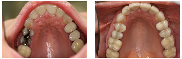Dental Crown Before and After Results Rochester Hills