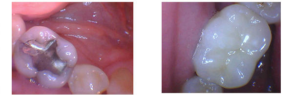 Dental Crowns and Bonding before and after results of a patient in Rochester Hills