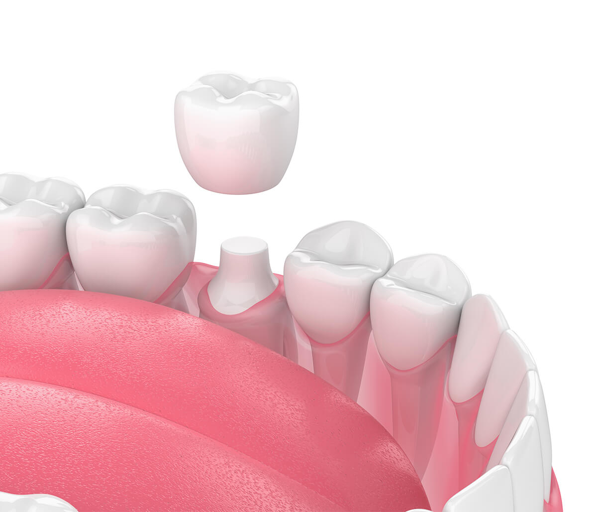 Dental Crowns for Cracked Teeth in Rochester MI Area