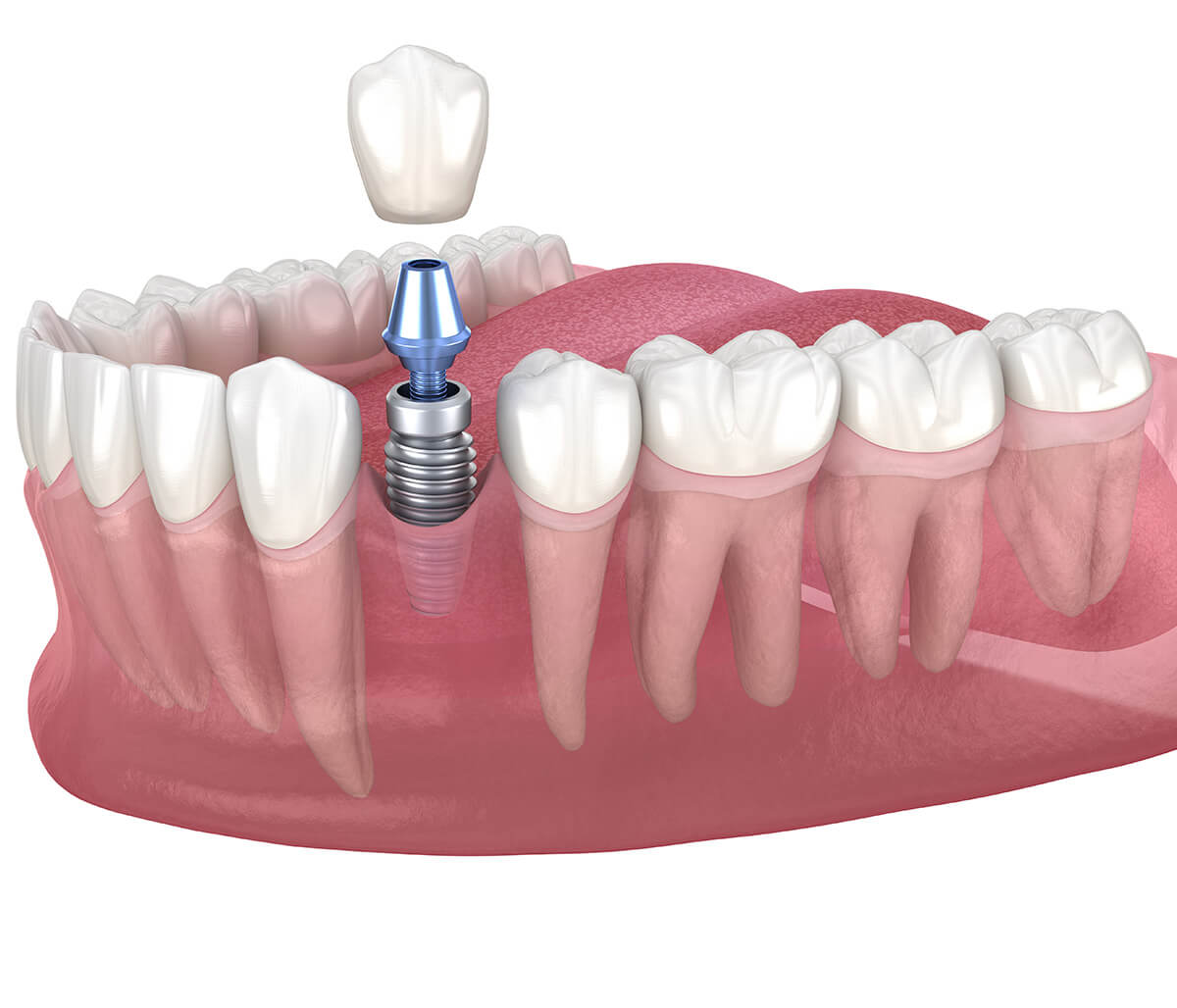 Dental Implant Surgery in Rochester MI Area
